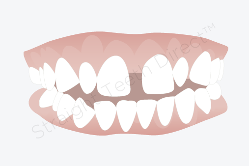 Tooth Gap PNG - 132617