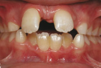 Tooth Gap PNG - 132622